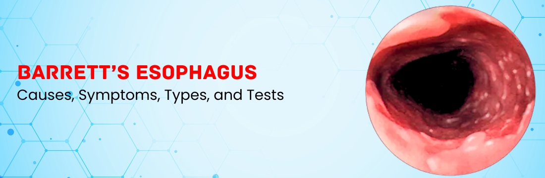 Barrett’s Esophagus Explained: Causes, Symptoms, and Tests for Diagnosis